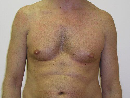 Gynecomastia Surgery Before & After Image