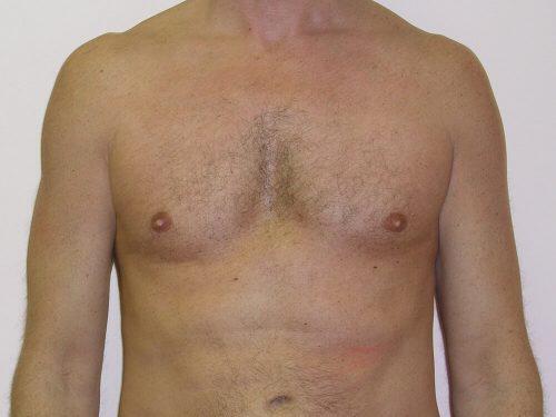 Gynecomastia Surgery Before & After Image