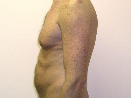 Gynecomastia Surgery Before & After Image