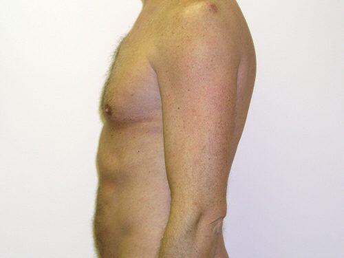 Gynecomastia Surgery Before & After Image