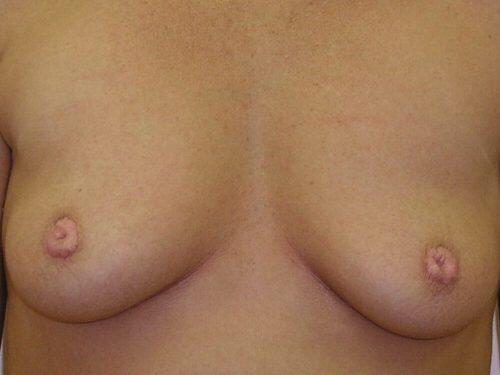 Nipple Correction Before & After Image