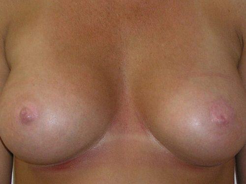 Nipple Correction Before & After Image