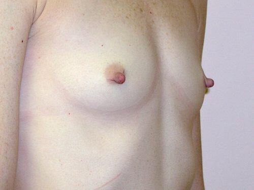 Nipple Correction Before & After Image