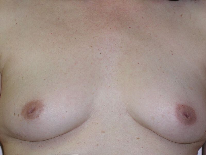 Nipple Correction Before & After Image