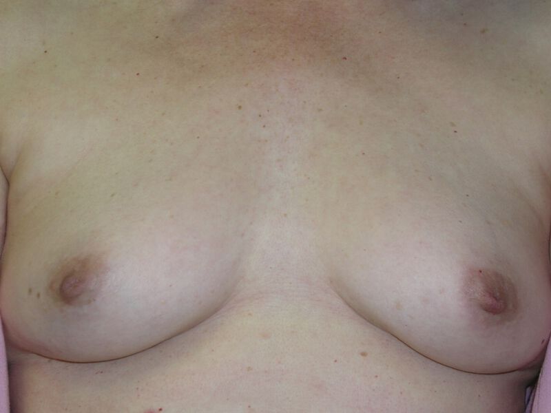 Nipple Correction Before & After Image