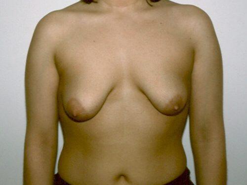 Tuberous Breast Before & After Image