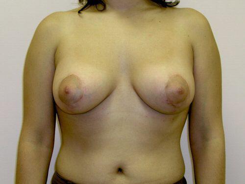 Tuberous Breast Before & After Image