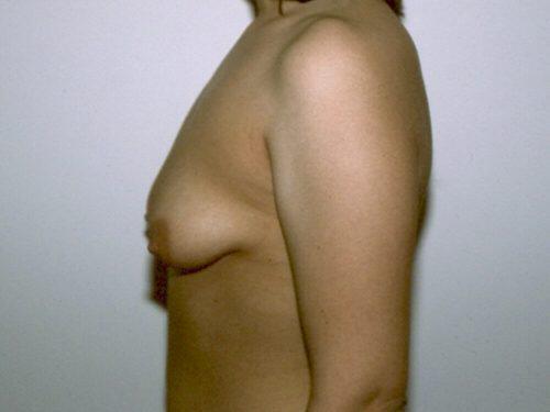 Tuberous Breast Before & After Image