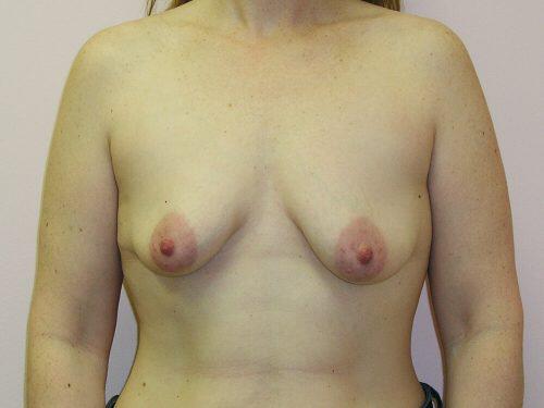 Tuberous Breast Before & After Image