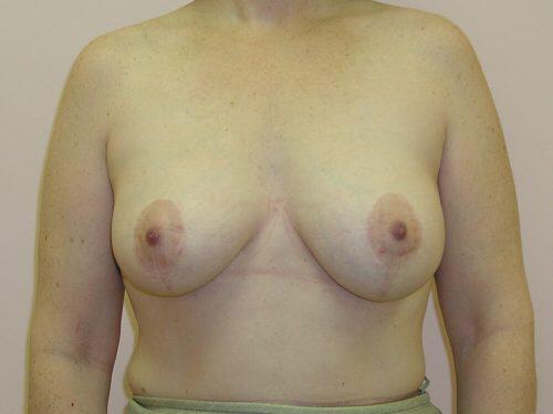 Tuberous Breast Before & After Image