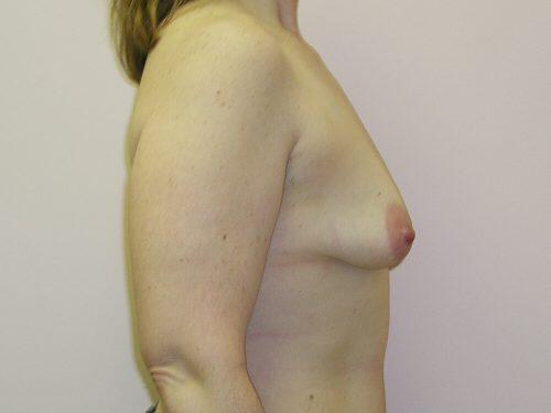 Tuberous Breast Before & After Image