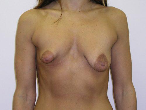 Tuberous Breast Before & After Image