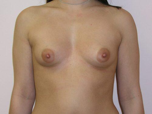 Tuberous Breast Before & After Image