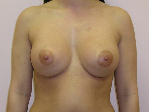 Tuberous Breast Before & After Image