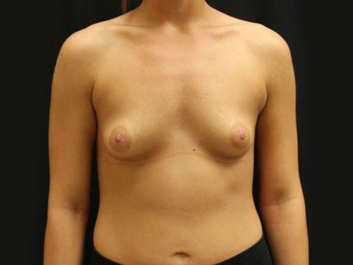 Tuberous Breast Before & After Image