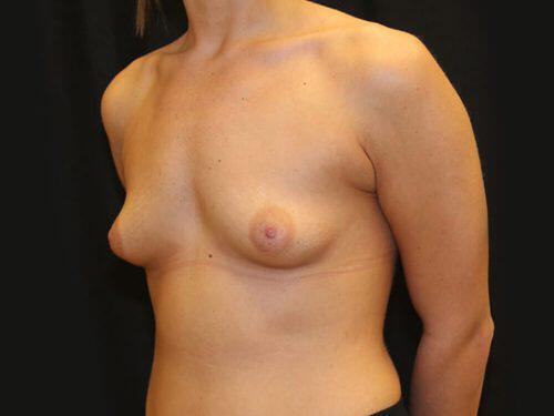 Tuberous Breast Before & After Image