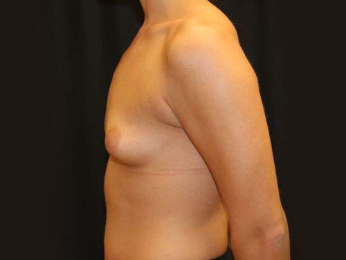 Tuberous Breast Before & After Image