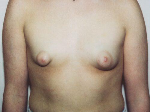 Tuberous Breast Before & After Image