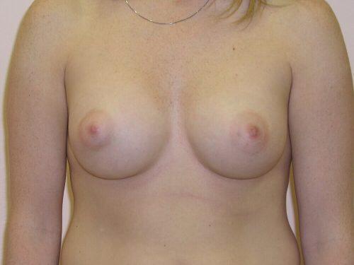 Tuberous Breast Before & After Image