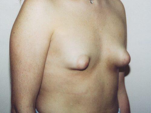 Tuberous Breast Before & After Image