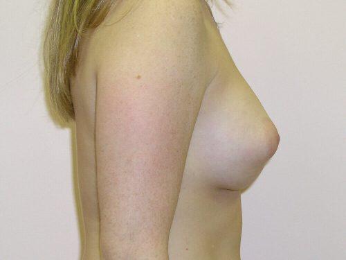 Tuberous Breast Before & After Image