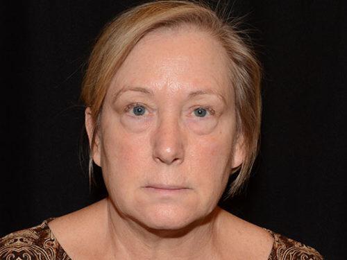 Blepharoplasty Before & After Image