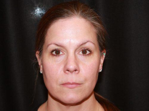 Botox | Dysport Before & After Image