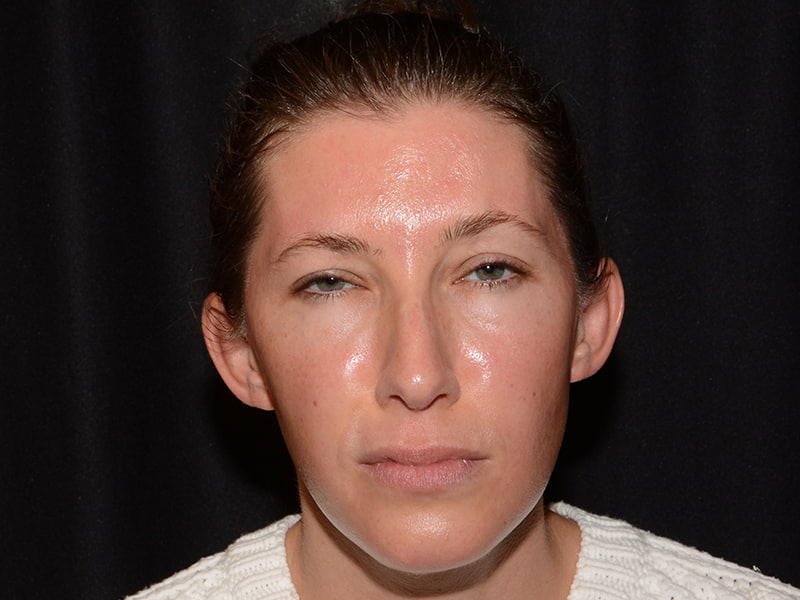 Botox | Dysport Before & After Image