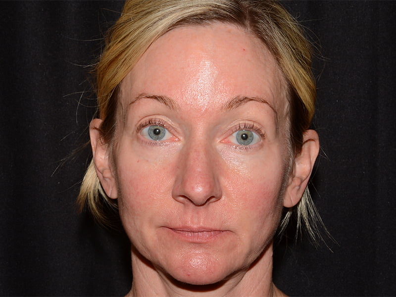 Botox | Dysport Before & After Image