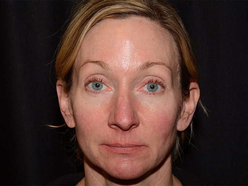 Botox | Dysport Before & After Image