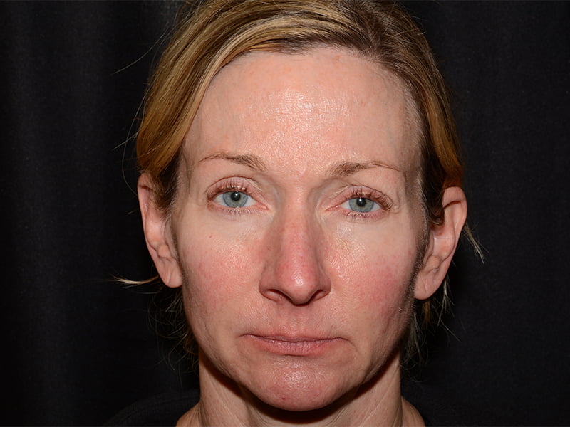 Botox | Dysport Before & After Image