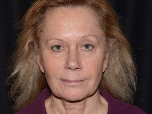 Facelift  Before & After Image