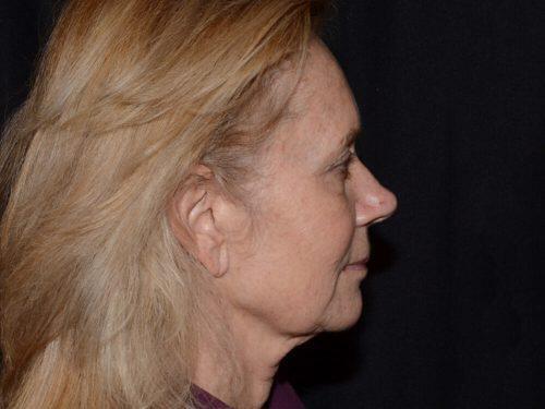 Facelift  Before & After Image