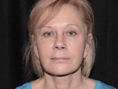 Facelift  Before & After Image