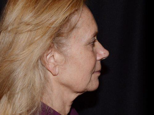 Facelift  Before & After Image