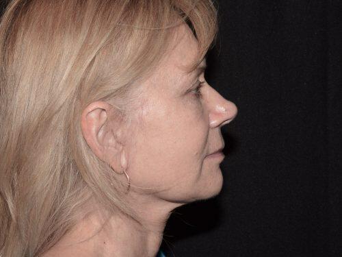 Facelift  Before & After Image