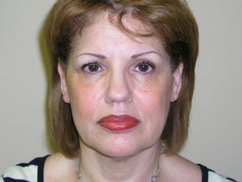 Facelift  Before & After Image