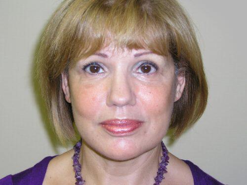 Facelift  Before & After Image