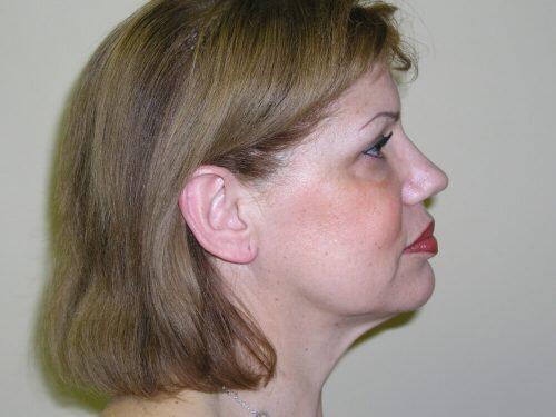 Facelift  Before & After Image