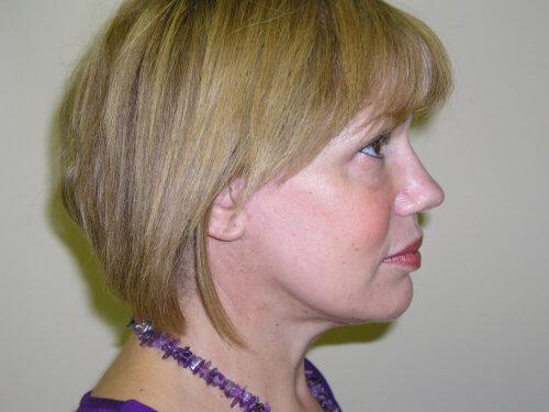 Facelift  Before & After Image