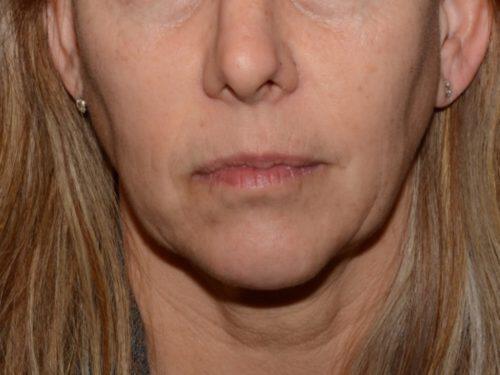 Dermal Fillers Before & After Image