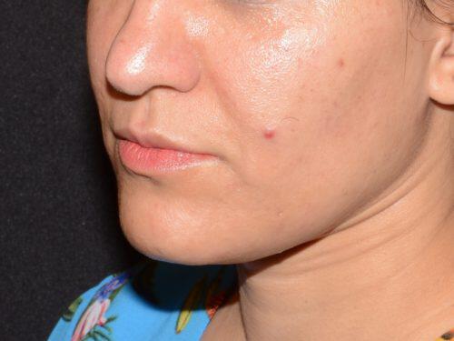 Dermal Fillers Before & After Image