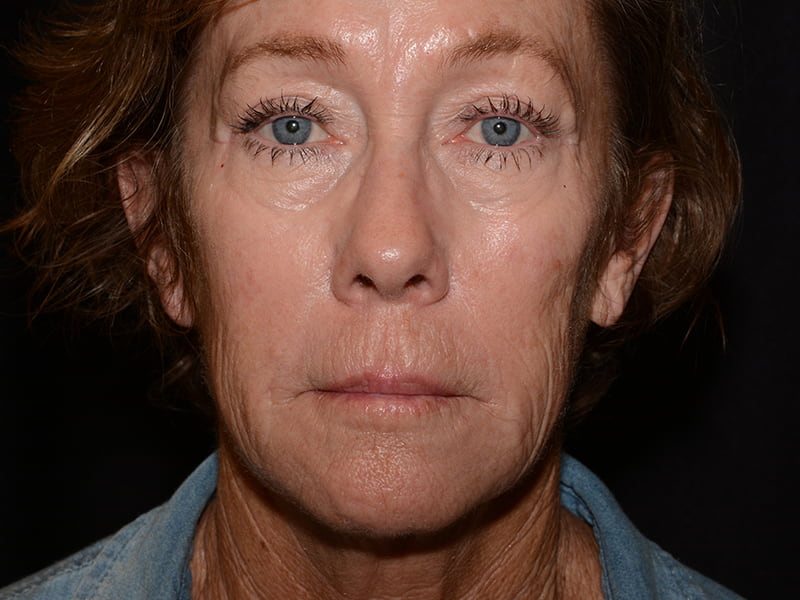 Dermal Fillers Before & After Image