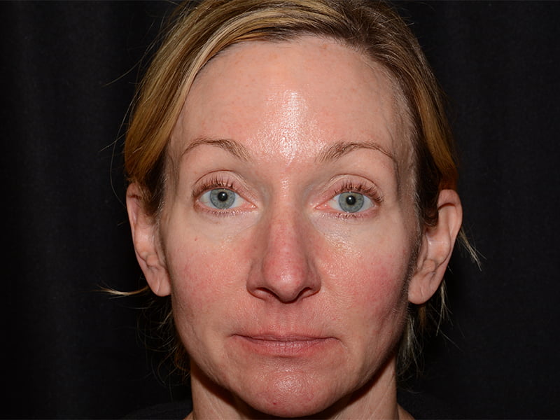 Dermal Fillers Before & After Image