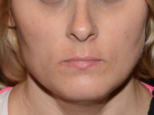 Lip Filler Before & After Image