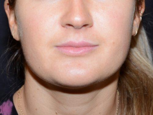 Lip Filler Before & After Image