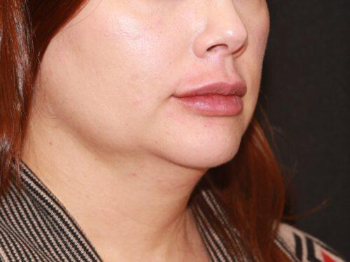 Lip Filler Before & After Image