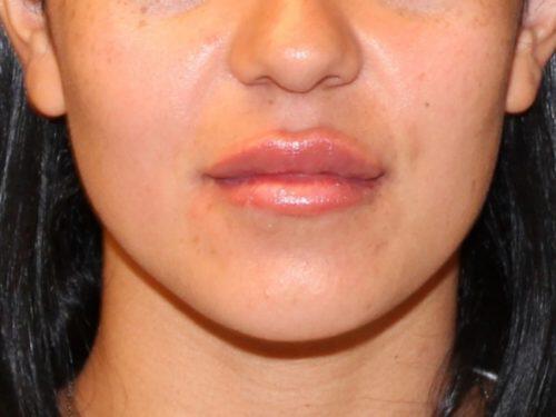 Lip Filler Before & After Image