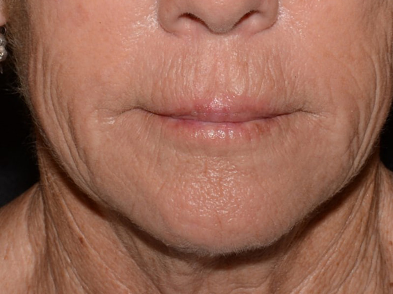 Lip Filler Before & After Image