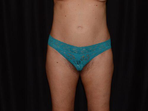 CoolSculpting  Before & After Image